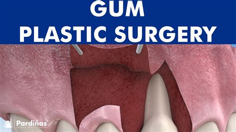 Gum Plastic Surgery Laterally Positioned Flap For Root Coverage