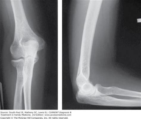 Upper Extremity Fracture