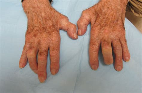 Osteoarthritis Nodules On Finger Joints