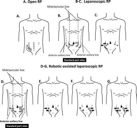 Skin Incision And Port Placement For The Radical Prostatectomy Rp A Download Scientific