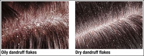 Dandruff The Difference Between Oily And Dry Dandruff