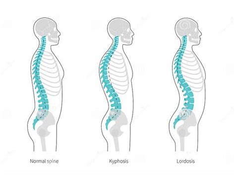 Kyphosis Lordosis Flat Vector Illustration Stock Vector