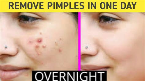 Clear Acne Pimple Pimple Marks How To Remove Pimples Acne