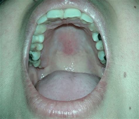 Ulcerative Palatal Lesions Download Scientific Diagram