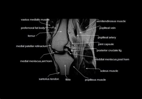Knee Muscle Anatomy Axial Mri Mri Knee Joint Anatomy It Is