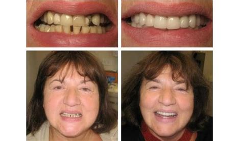 Implante Dentário Fotos De Antes E Depois