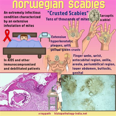 Norwegian Scabies Histology