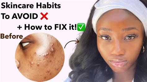 How I Damaged My Skin Barrier How I Fixed It Fast Repair Moisture