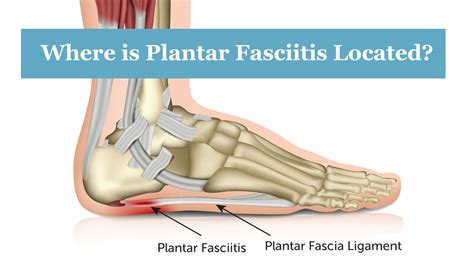 Plantar Fasciitis Treatment In Frisco Heel Pain Rnv Podiatry