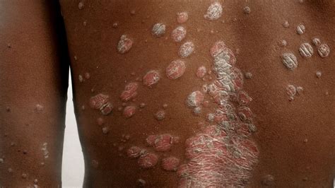 Psoriasis Strategies In Skin Of Color