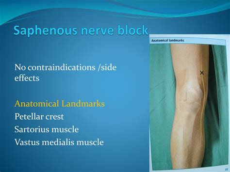 Saphenous Nerve Block Overview Indications Contraindications My Xxx