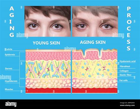 The Younger Skin And Aging Skin Elastin And Collagen A Diagram Of