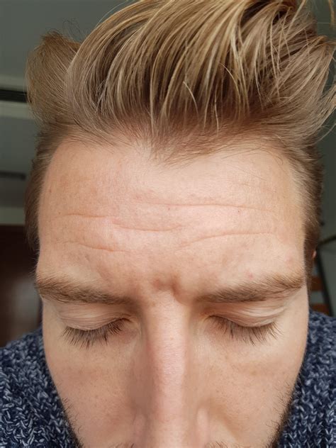 Small Bumps On Foreheadnot Sure If Acne Or Not General Acne