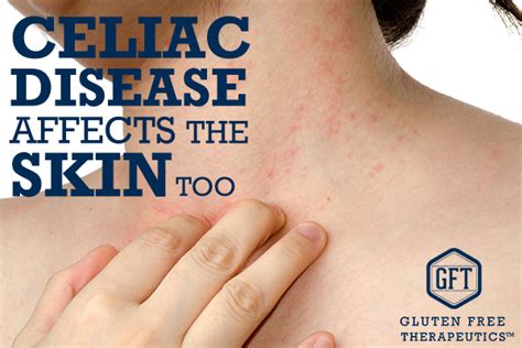 Skin Rash And Celiac Disease Gluten Free Therapeutics