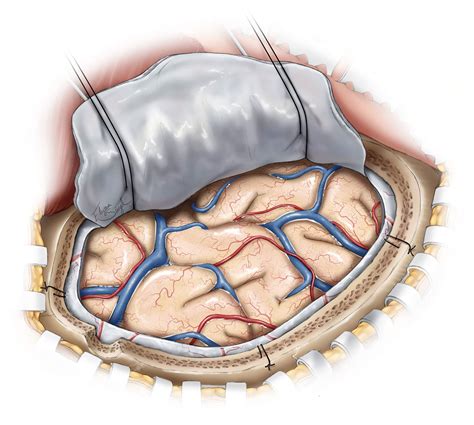 Acute Subdural Hematoma The Neurosurgical Atlas