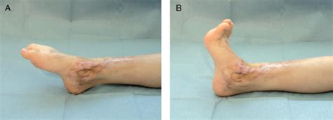 Extensive Loss Of Tibialis Anterior Tendon Surgical Repair With Split