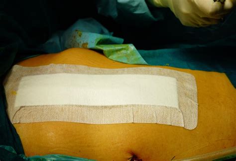 C Section Scar Complications Care Treatment Healing Tips