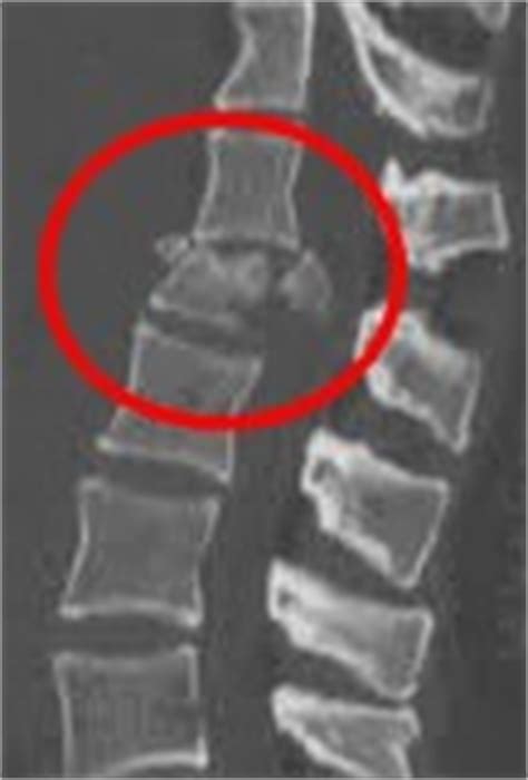 Si on vous a diagnostiqué une fracture vertébrale causée par l'ostéoporose, etc., la cyphoplastie par options thérapeutiques pour les fractures vertébrales. Traumatologie du rachis