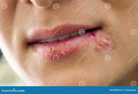 Herpes On The Lips Stock Photo Image 59925372