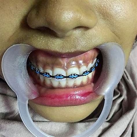 Pin By John Beeson On Orthodontic Braces In 2021 Orthodontics Braces