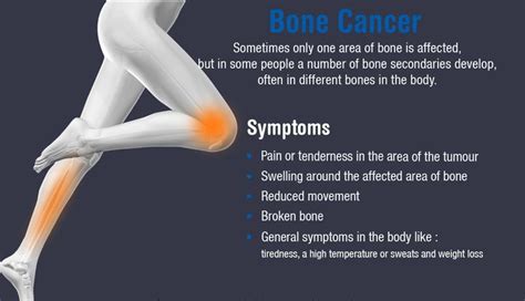 Bone Cancer In Knee Joint Symptoms Doctorvisit