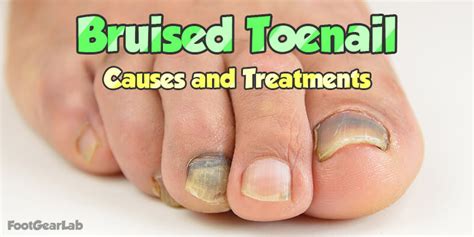 Bruised Toenail Learn About Its Causes Treatment And Prevention