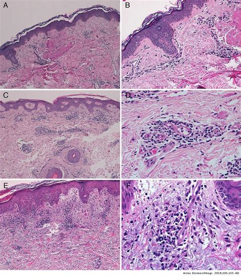 Management Of Refractory Telaprevir Induced Dermatitis Using Oral