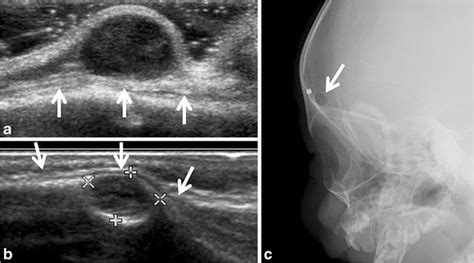 Sonography Of Pediatric Superficial Lumps And Bumps Illustrative