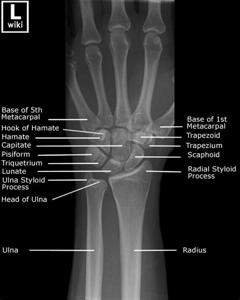 Wrist Radiographic Anatomy Wikiradiography
