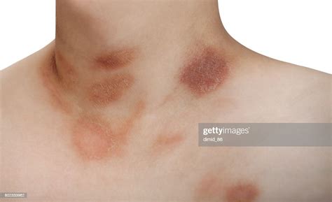 One Person With Pityriasis Rosea Disease On The Chest And Neck High Res