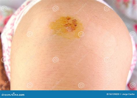 Scraped Knee Of A Little Boy Close Up Wounds Abrasions Bruises