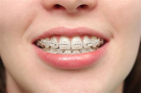 Types Of Braces Trusted Orthodontist In Texas