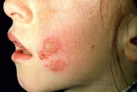 We have never had symptoms on our face. Oral Herpes - Symptoms, Pictures, Causes, Treatment