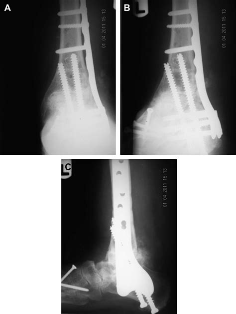 Total Ankle Replacements An Overview Clinics In Podiatric Medicine And Surgery
