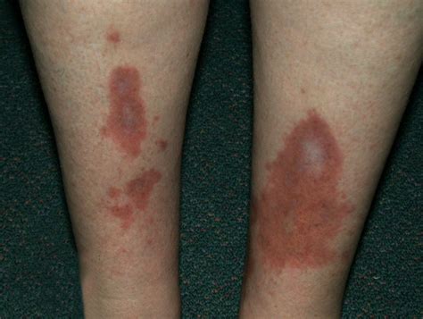 Diabetic Spots On Skin