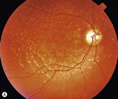 Inherited Macular Dystrophies Ento Key