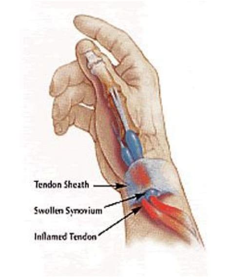 Tenosinovitis De Quervain Quervains Tenosinovitis Chiropracticwellness