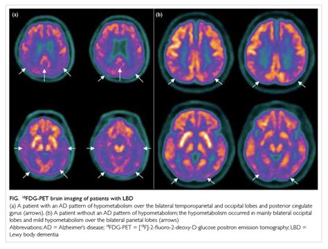 A Descriptive Study Of Lewy Body Dementia With Functional Imaging