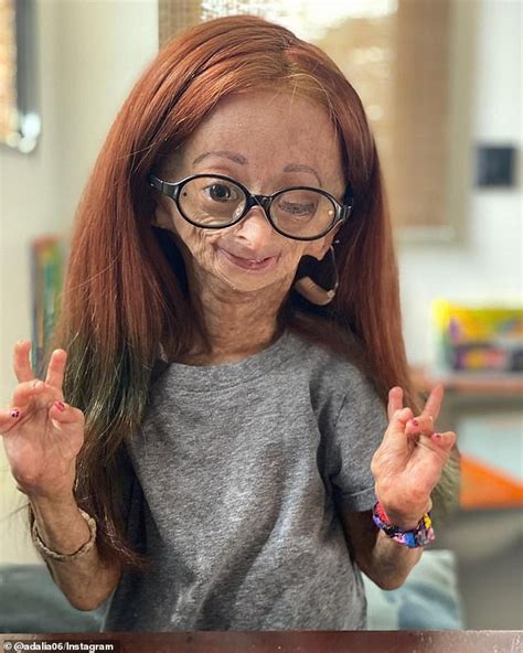 Youtube Star Who Battled Real Life Benjamin Button Disease Dies At The Age Of 15 Duk News
