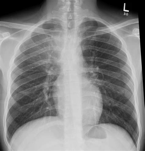 Tuberculosis Of The Chest Wall Image