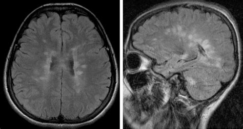 Multiple Sclerosis Radiology Cases