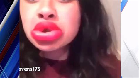 Doctors Warn About Long Lasting Effects Of ‘kylie Jenner Challenge