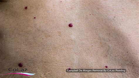 Blood Spots Removal Campbell De Morgan Spots Cherry Angioma Youtube
