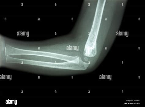 Film X Ray Of Child S Elbow Normal Child S Elbow Side View