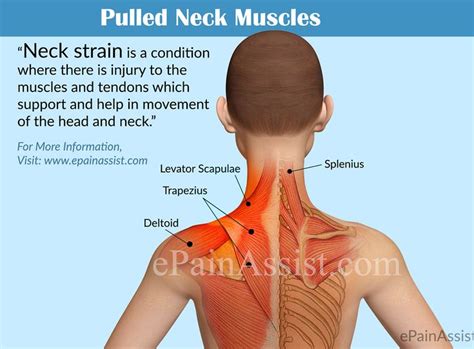 Pin By Hperez On Impact Of Technology On Physical Health Pulled Neck Muscle Muscles Of The