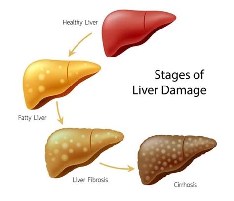 Liver Function Of A Liver Harmful Factors Symptoms Liver Diseases