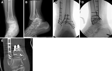 Example Of An Ankle Fracture Dislocation With A Malreduction On