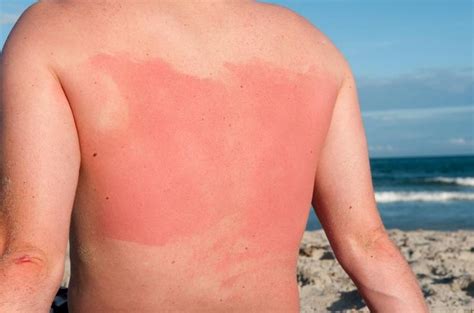 9 Most Effective Home Remedies To Heal A Sunburn Fast With Images