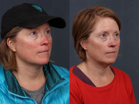 Excel V Laser Treatment Before And After Photos Patient 693 Louisville
