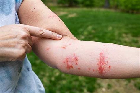 Did You Know That Allergic Reactions To A Poison Ivy Plant Touching